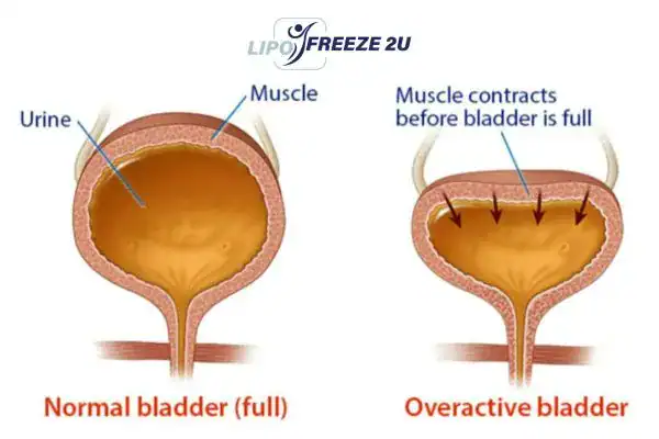 diagram of overactive bladder treatment Wembley Park