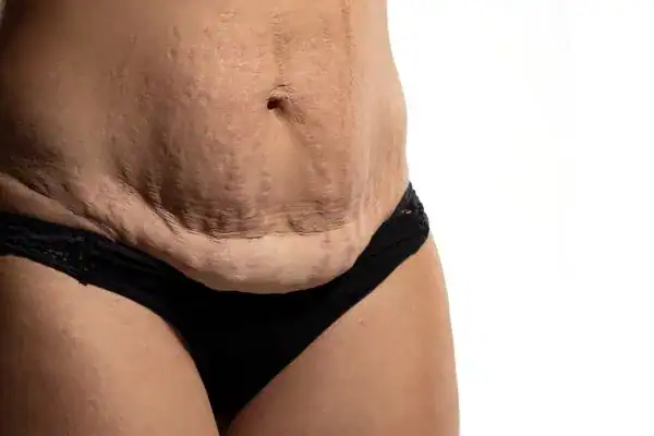loose skin after weight loss injections Wembley Park