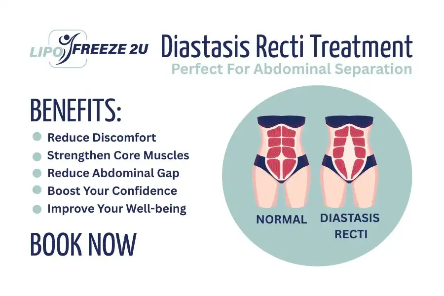 How Long Will It Take to See Improvements in Diastasis Recti Wembley Park