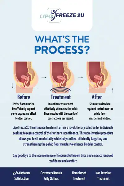 Diagram of how incontinence treatment Wembley Park works.