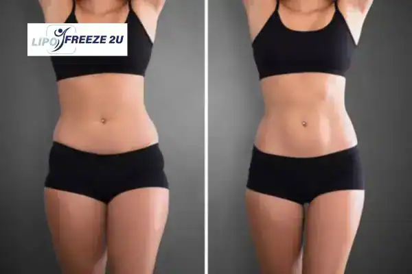 How Can LIPO FREEZE 2U Support Your Post-Pregnancy Body Recovery Wembley Park?