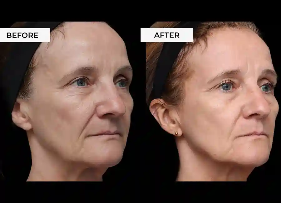 How Many RF Microneedling Sessions Will You Need to See a Difference Wembley Park?