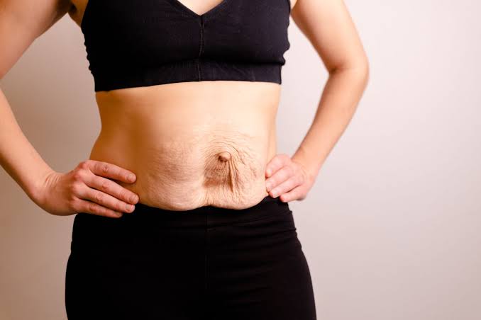 Is Surgery Really the Only Way to Repair Diastasis Recti Wembley Park?