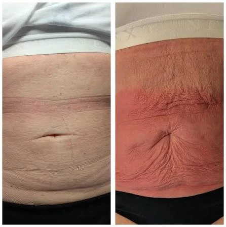 How Does RF Microneedling Improve Crepey, Thin and Uneven Skin Texture Wembley Park?