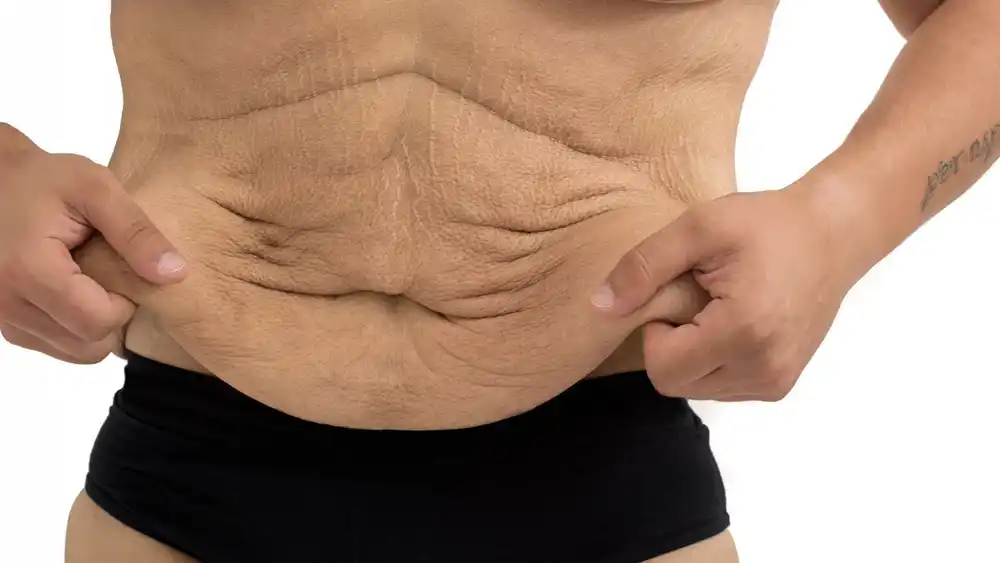 RF Microneedling for Loose Skin: How Can It Help Tighten and Reshape the Skin Wembley Park?
